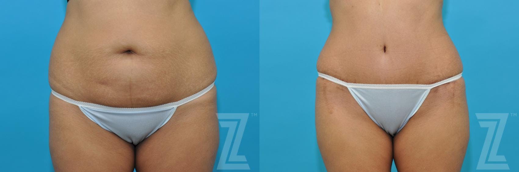 Tummy Tuck Before & After Gallery - Patient 132886811 - Image 1