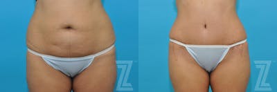 Austin Tummy Tuck Before & After Gallery - Patient 132886811 - Image 1 - The Piazza Center