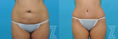 Tummy Tuck Before & After Gallery - Patient 132886811 - Image 1