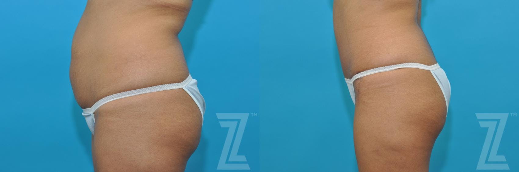 Tummy Tuck Before & After Gallery - Patient 132886811 - Image 2