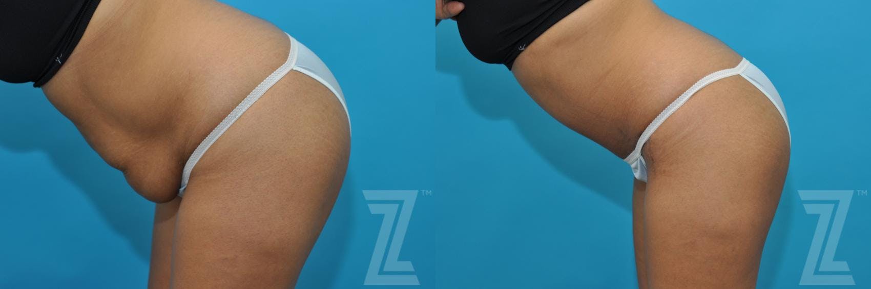 Tummy Tuck Before & After Gallery - Patient 132886811 - Image 3