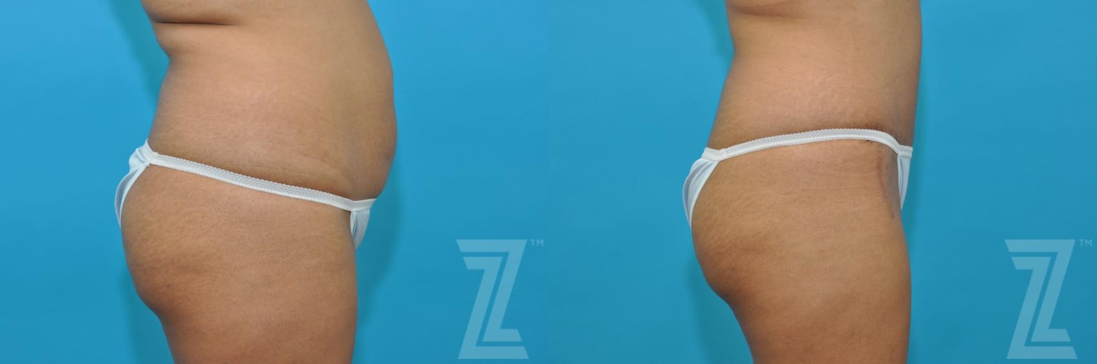Austin Tummy Tuck Before & After Gallery - Patient 132886811 - Image 4 - The Piazza Center