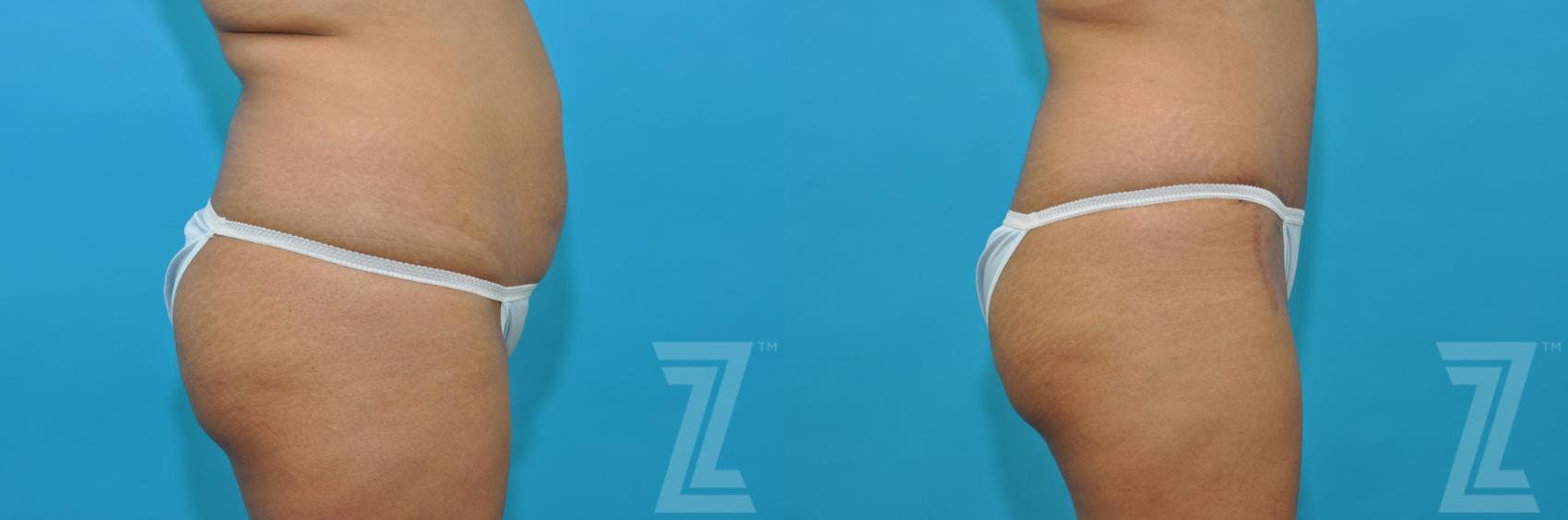 Tummy Tuck Before & After Gallery - Patient 132886811 - Image 4