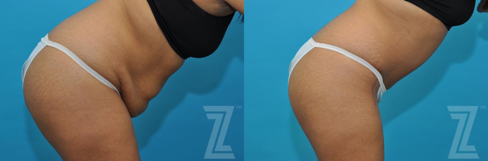 Tummy Tuck Before & After Gallery - Patient 132886811 - Image 5