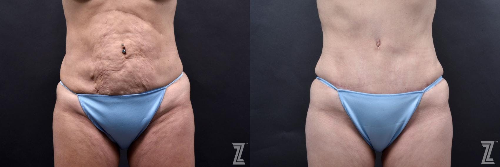 Tummy Tuck Before & After Gallery - Patient 132886812 - Image 1