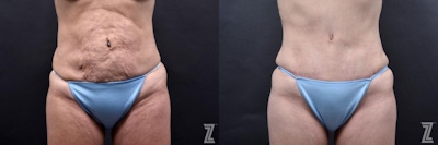 Tummy Tuck Before & After Gallery - Patient 132886812 - Image 1
