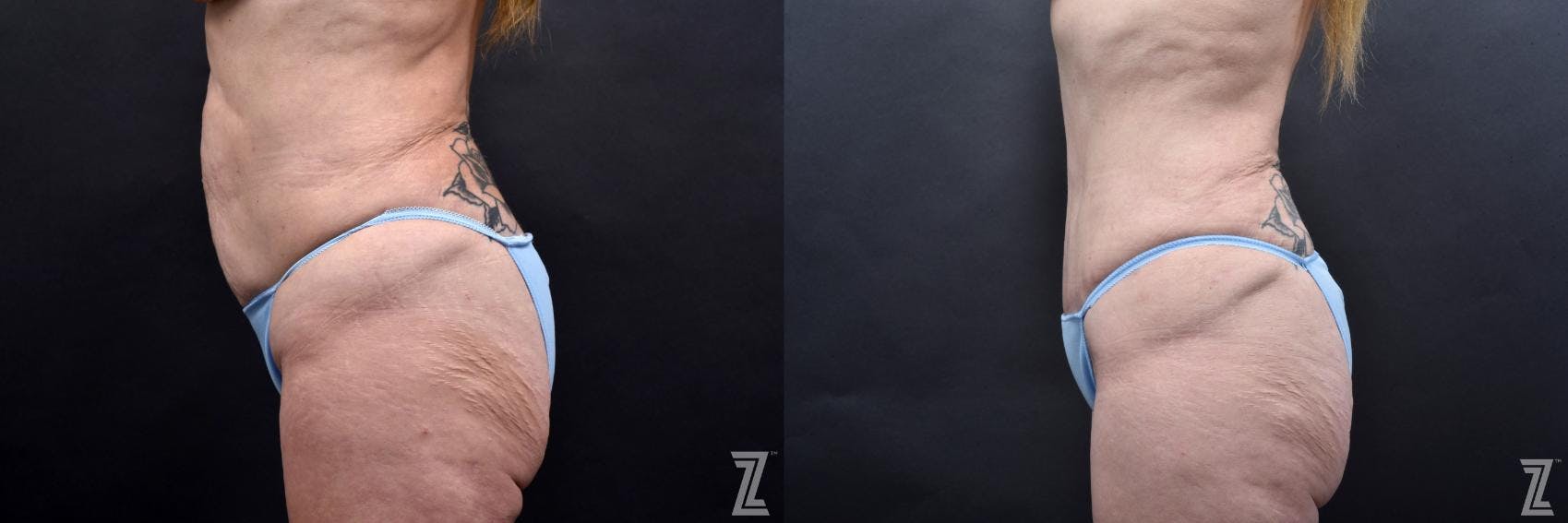 Tummy Tuck Before & After Gallery - Patient 132886812 - Image 2