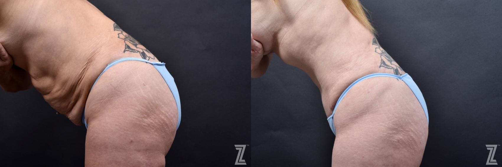 Tummy Tuck Before & After Gallery - Patient 132886812 - Image 3