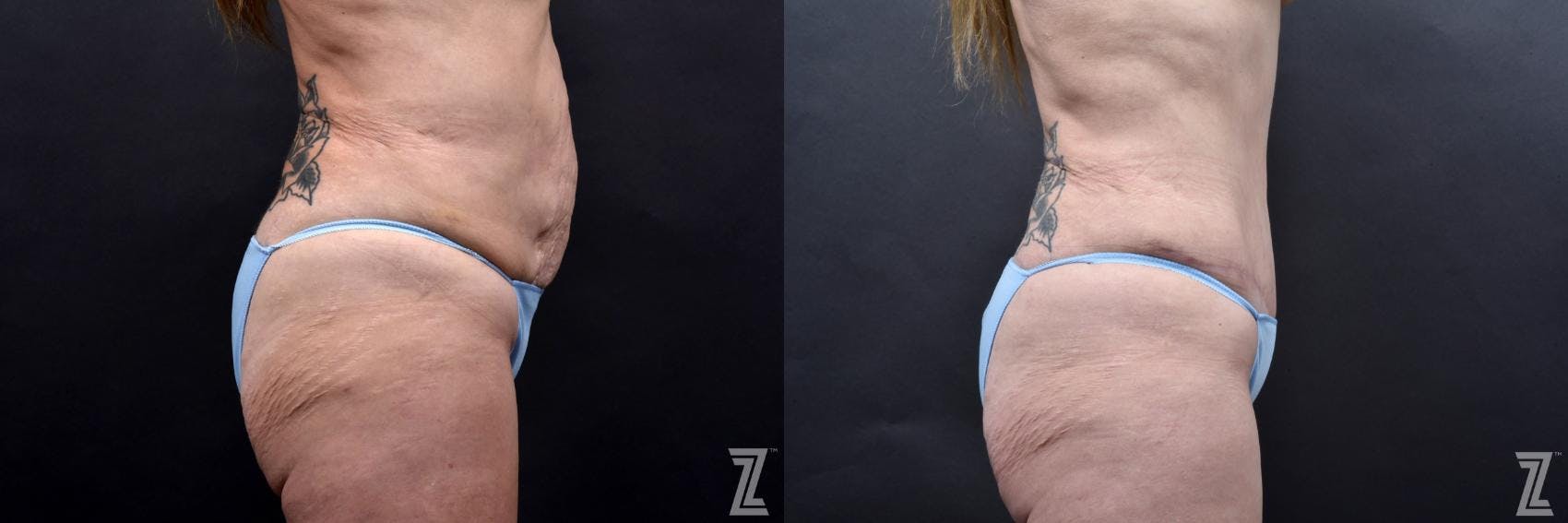 Tummy Tuck Before & After Gallery - Patient 132886812 - Image 4