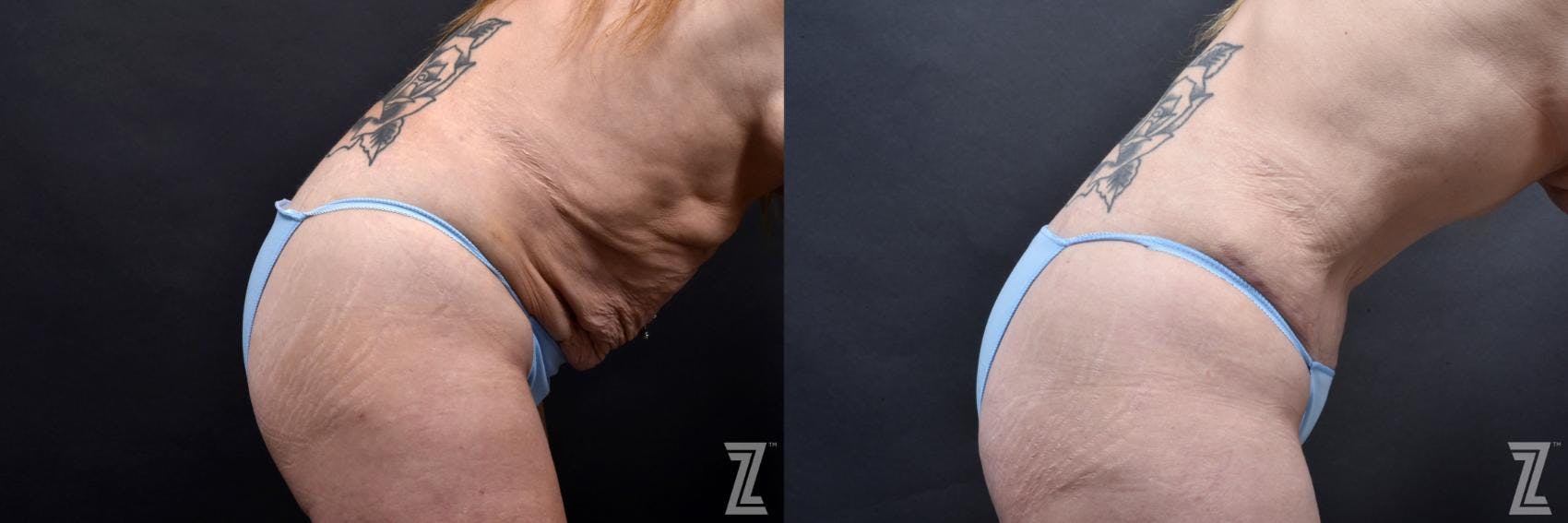 Tummy Tuck Before & After Gallery - Patient 132886812 - Image 5