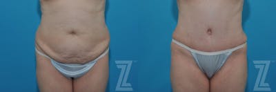 Austin Tummy Tuck Before & After Gallery - Patient 132886813 - Image 1 - The Piazza Center