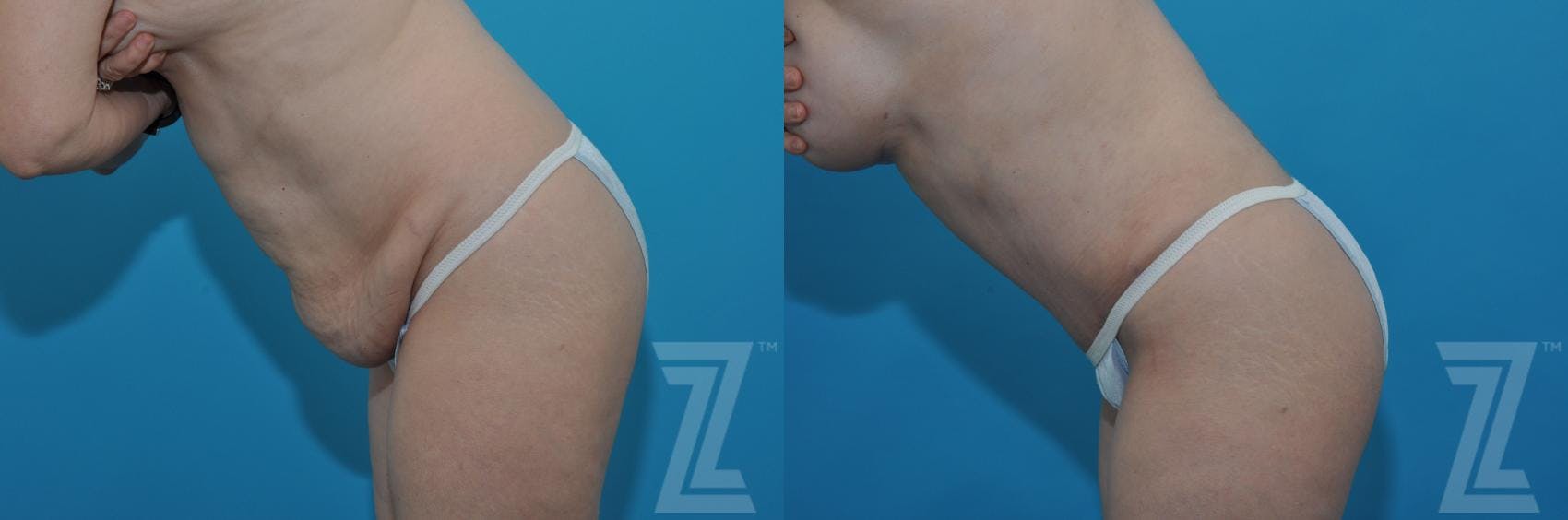 Tummy Tuck Before & After Gallery - Patient 132886813 - Image 3
