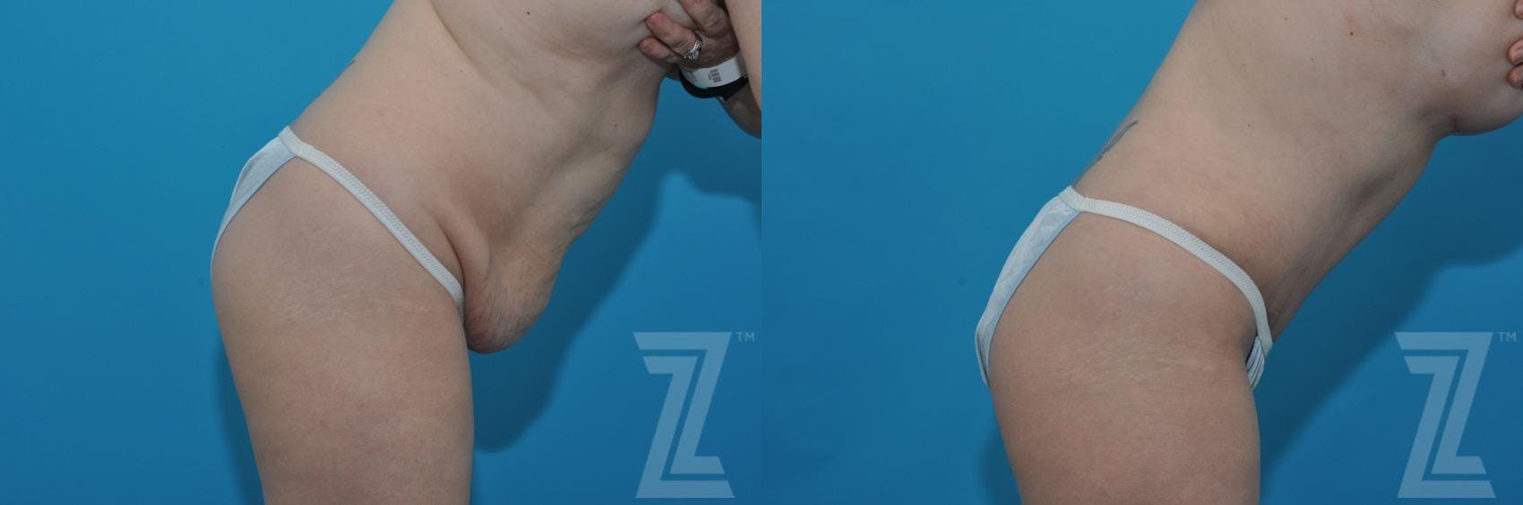 Tummy Tuck Before & After Gallery - Patient 132886813 - Image 5