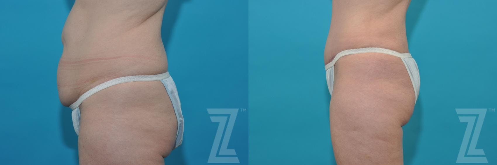 Tummy Tuck Before & After Gallery - Patient 132886814 - Image 2
