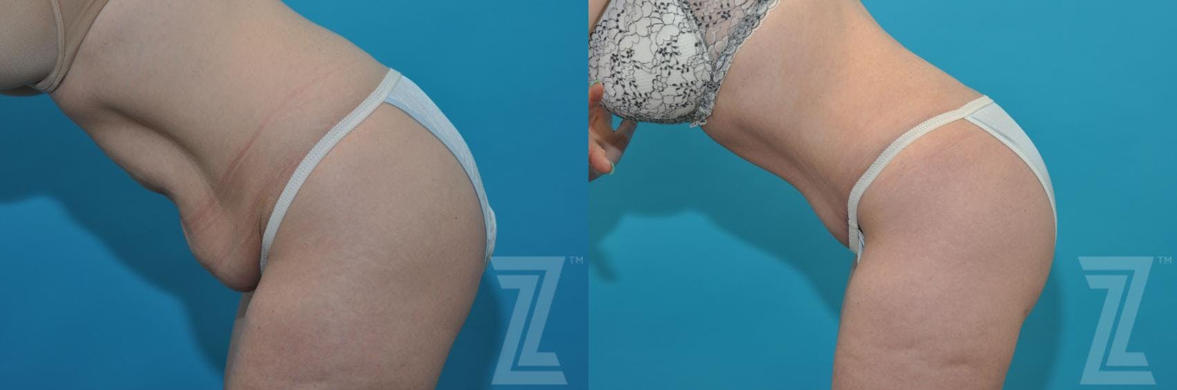 Tummy Tuck Before & After Gallery - Patient 132886814 - Image 3
