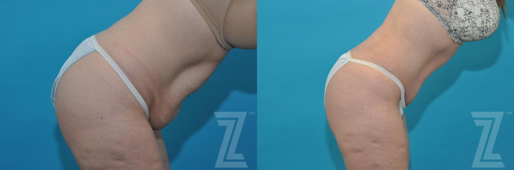 Tummy Tuck Before & After Gallery - Patient 132886814 - Image 5