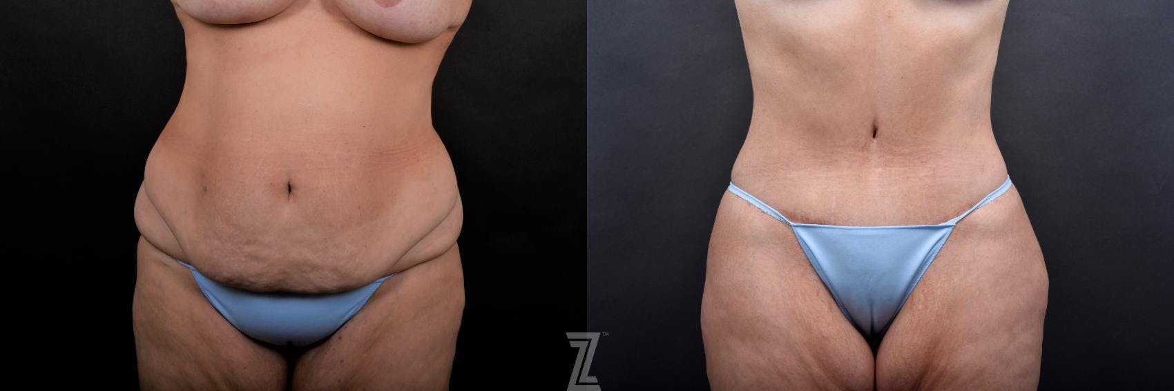 Tummy Tuck Before & After Gallery - Patient 132886815 - Image 1