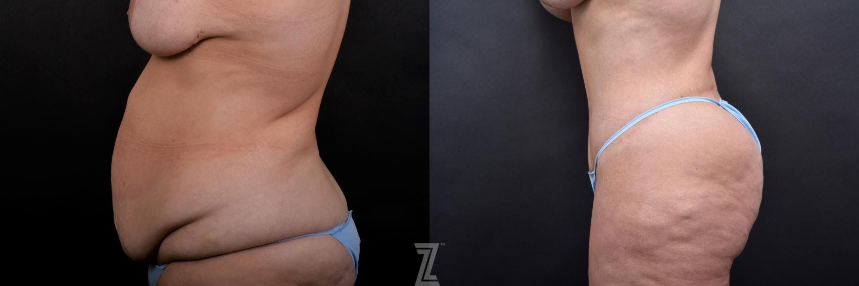 Tummy Tuck Before & After Gallery - Patient 132886815 - Image 2