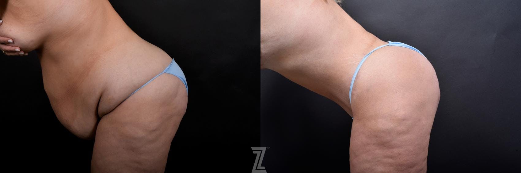 Tummy Tuck Before & After Gallery - Patient 132886815 - Image 3