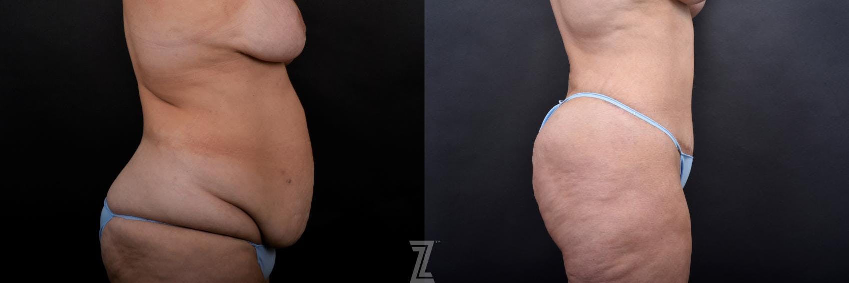 Tummy Tuck Before & After Gallery - Patient 132886815 - Image 4