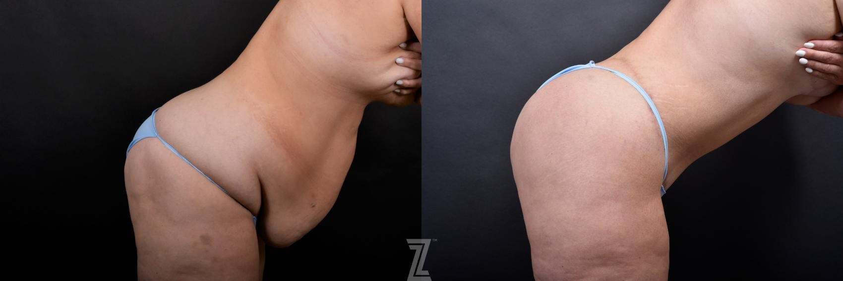 Tummy Tuck Before & After Gallery - Patient 132886815 - Image 5