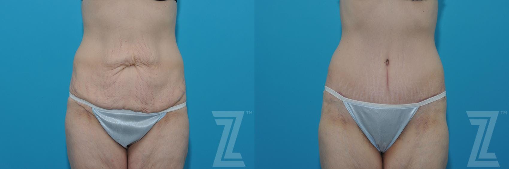 Tummy Tuck Before & After Gallery - Patient 132886817 - Image 1