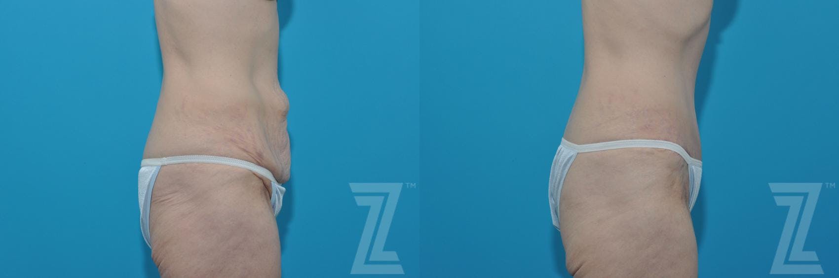 Tummy Tuck Before & After Gallery - Patient 132886817 - Image 4