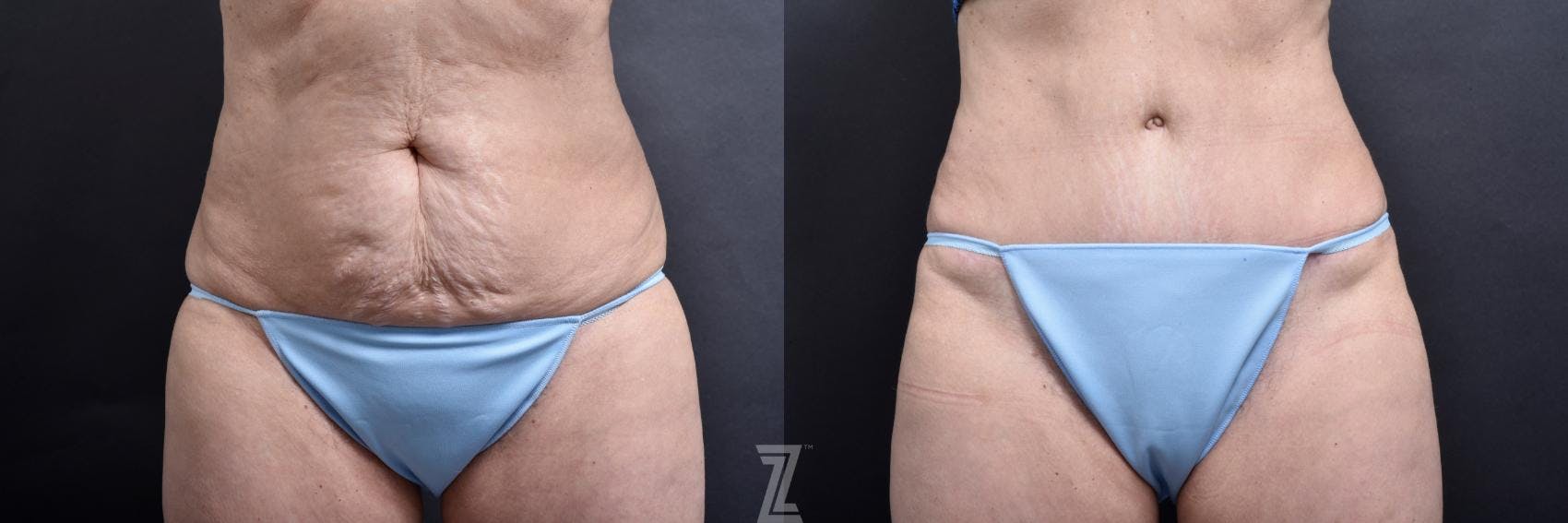 Tummy Tuck Before & After Gallery - Patient 132886818 - Image 1