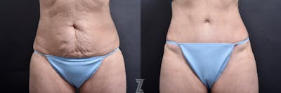 Austin Tummy Tuck Before & After Gallery - Patient 132886818 - Image 1 - The Piazza Center