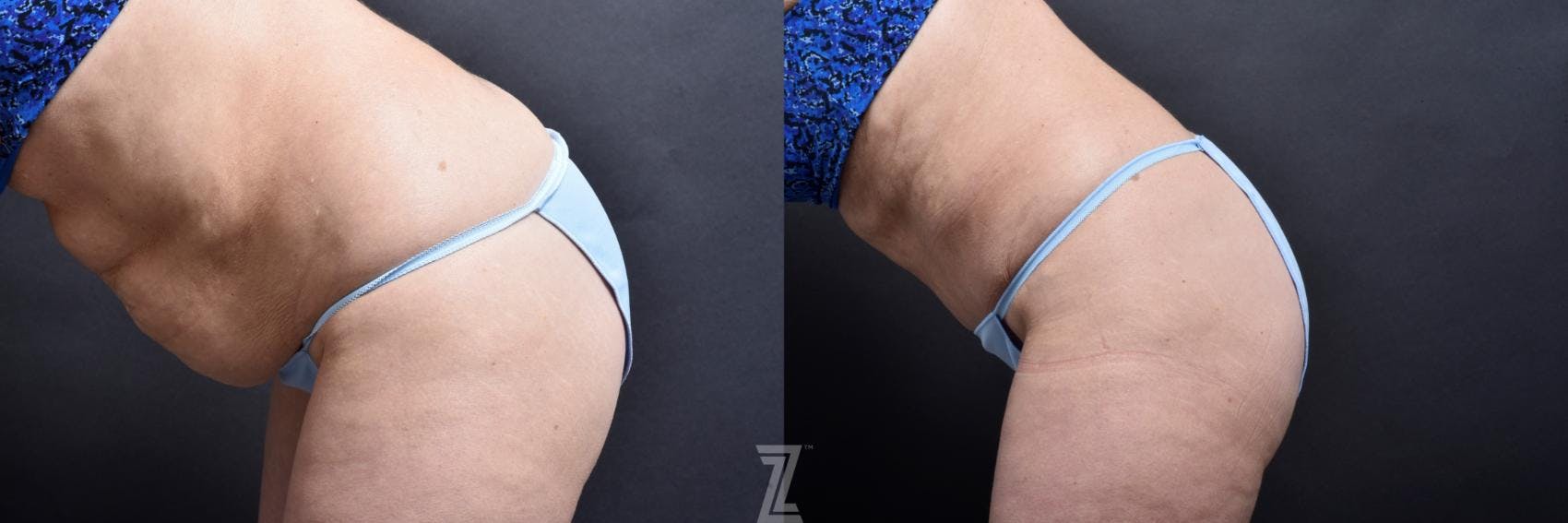 Tummy Tuck Before & After Gallery - Patient 132886818 - Image 2