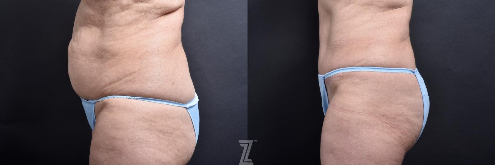 Tummy Tuck Before & After Gallery - Patient 132886818 - Image 3