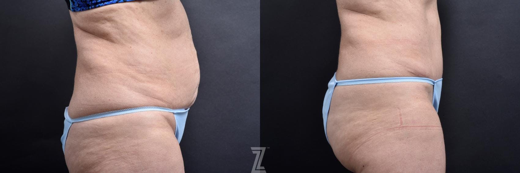 Tummy Tuck Before & After Gallery - Patient 132886818 - Image 4