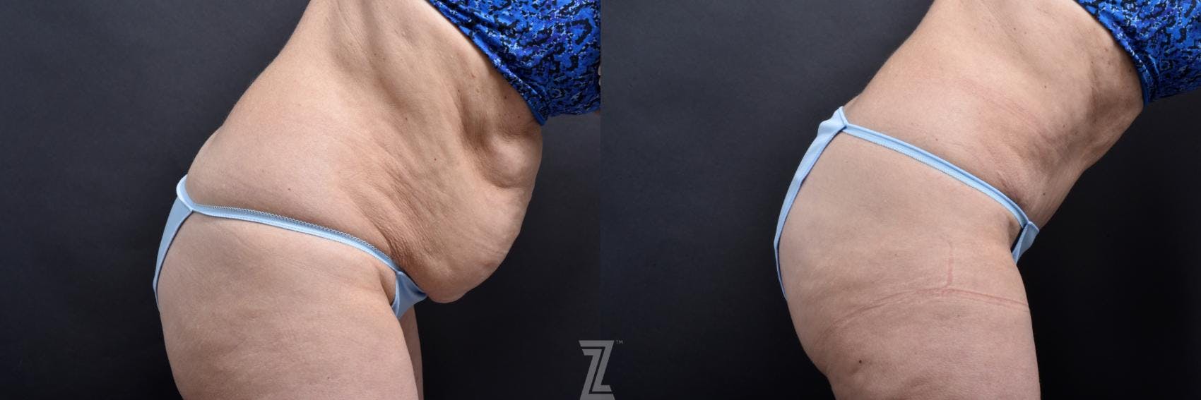 Tummy Tuck Before & After Gallery - Patient 132886818 - Image 5