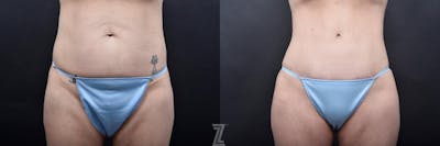 Austin Tummy Tuck Before & After Gallery - Patient 132886820 - Image 1 - The Piazza Center