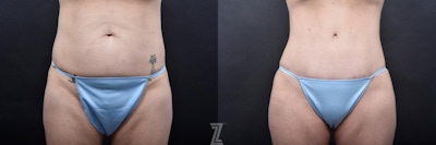 Tummy Tuck Before & After Gallery - Patient 132886820 - Image 1
