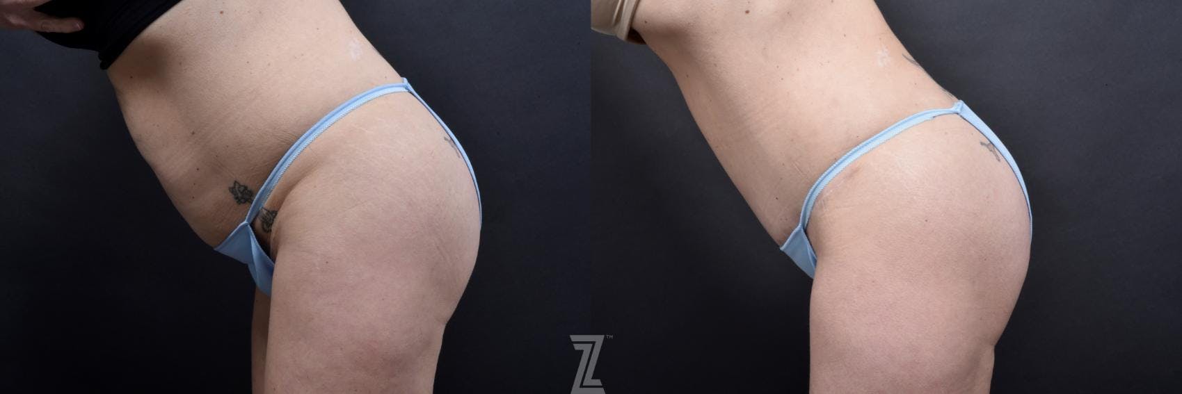 Tummy Tuck Before & After Gallery - Patient 132886820 - Image 3