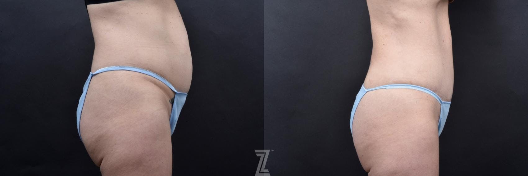 Tummy Tuck Before & After Gallery - Patient 132886820 - Image 4