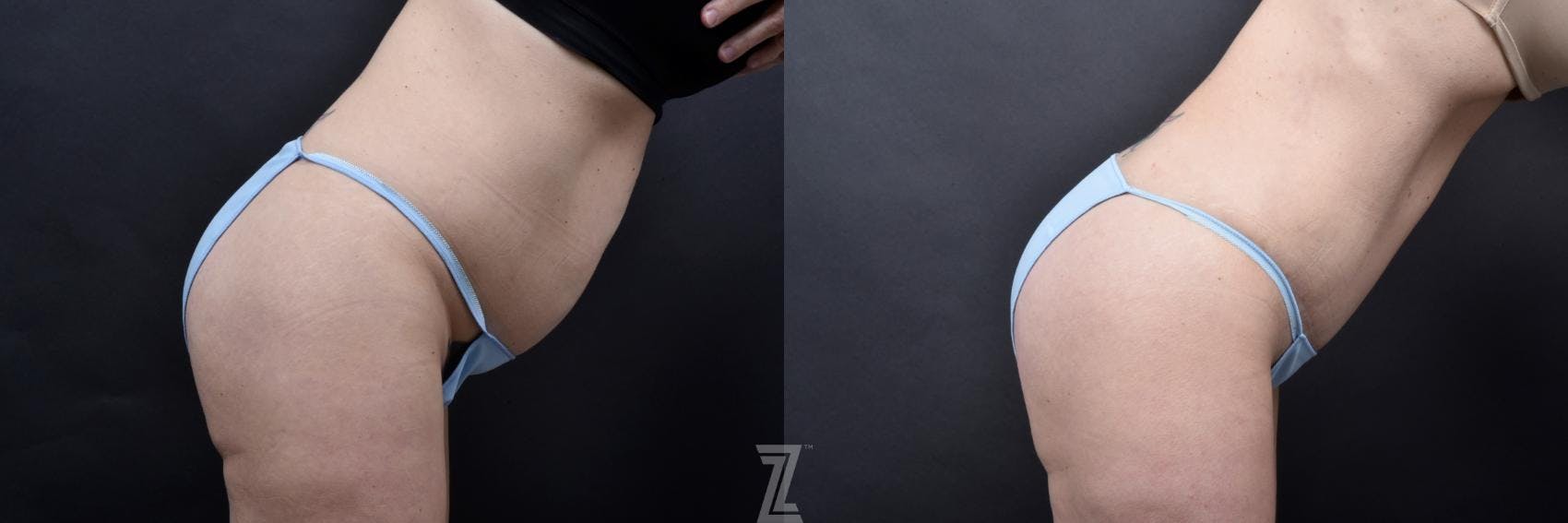 Tummy Tuck Before & After Gallery - Patient 132886820 - Image 5