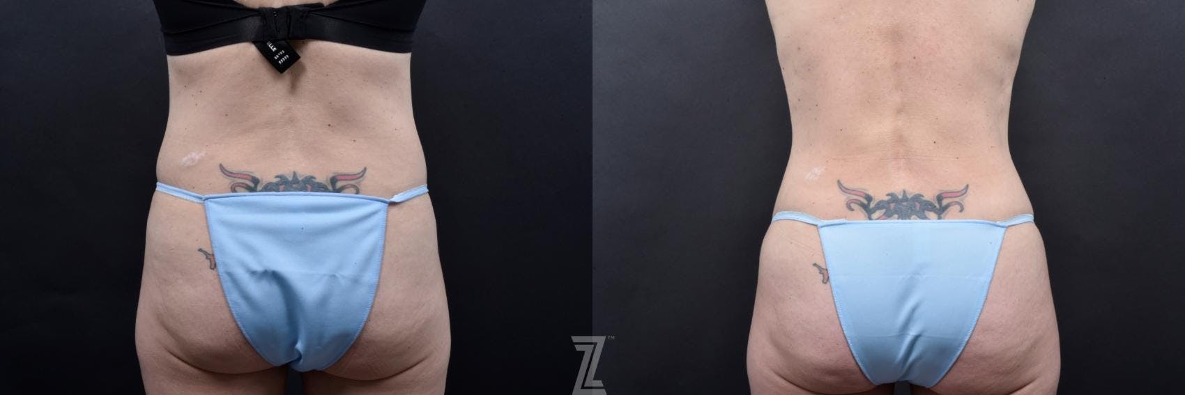 Tummy Tuck Before & After Gallery - Patient 132886820 - Image 6