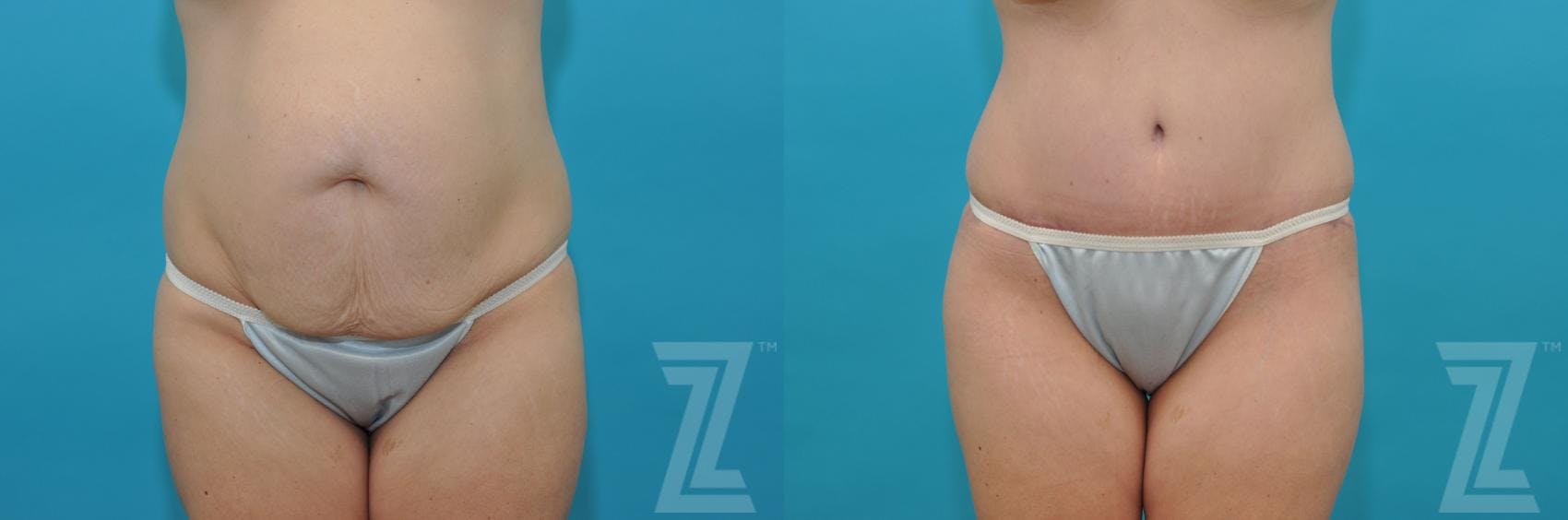 Tummy Tuck Before & After Gallery - Patient 132886822 - Image 1