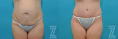 Austin Tummy Tuck Before & After Gallery - Patient 132886822 - Image 1 - The Piazza Center