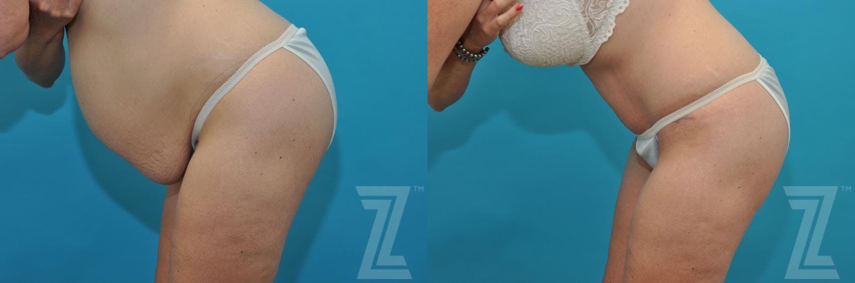 Tummy Tuck Before & After Gallery - Patient 132886822 - Image 3