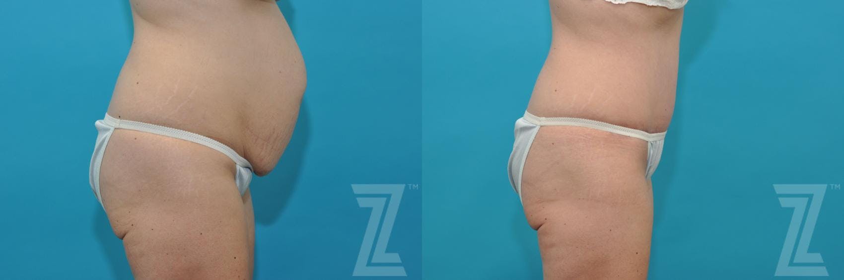 Tummy Tuck Before & After Gallery - Patient 132886822 - Image 4