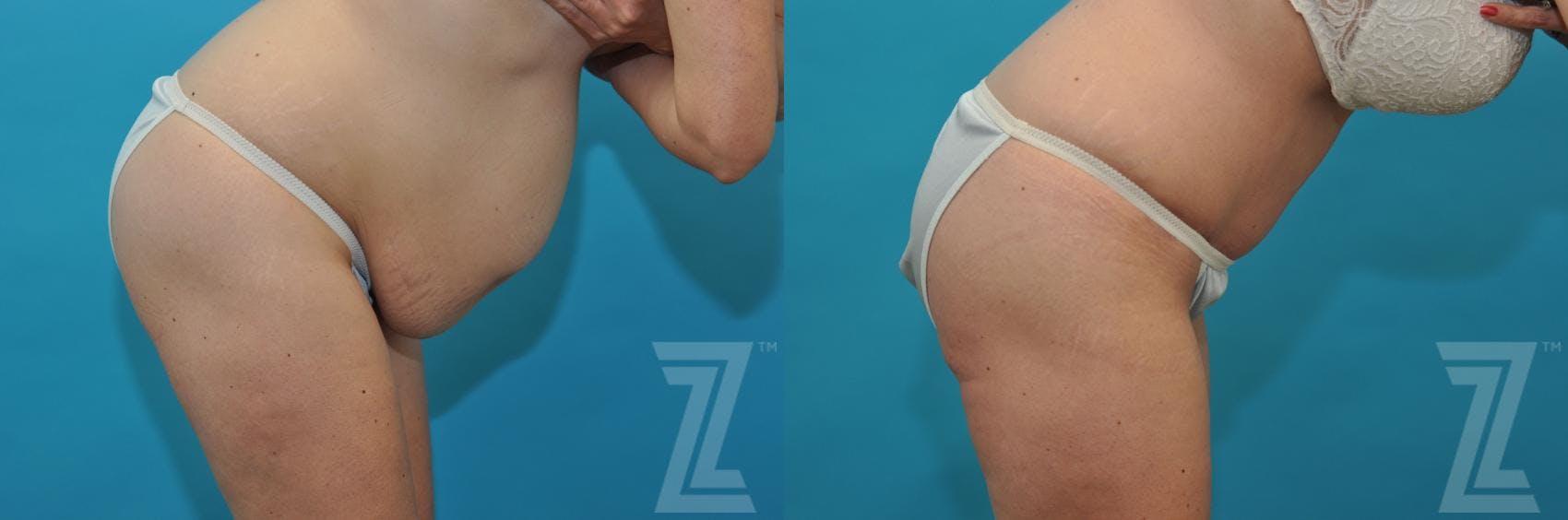Tummy Tuck Before & After Gallery - Patient 132886822 - Image 5