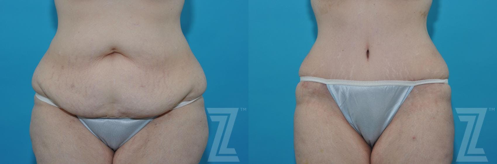 Tummy Tuck Before & After Gallery - Patient 132886824 - Image 1