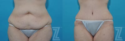 Austin Tummy Tuck Before & After Gallery - Patient 132886824 - Image 1 - The Piazza Center