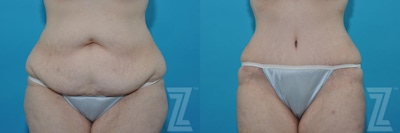 Tummy Tuck Before & After Gallery - Patient 132886824 - Image 1