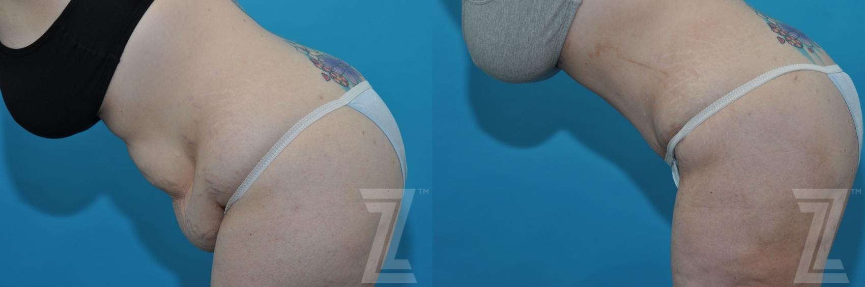 Tummy Tuck Before & After Gallery - Patient 132886824 - Image 3