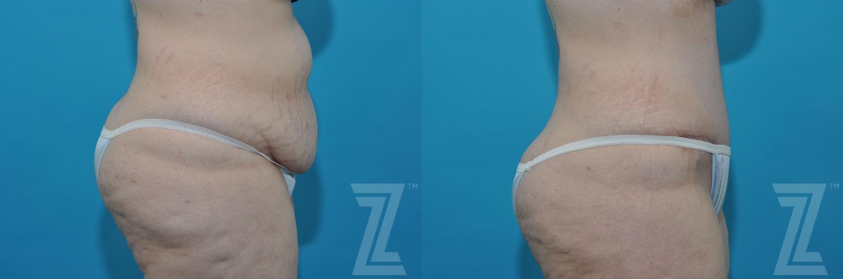 Tummy Tuck Before & After Gallery - Patient 132886824 - Image 5