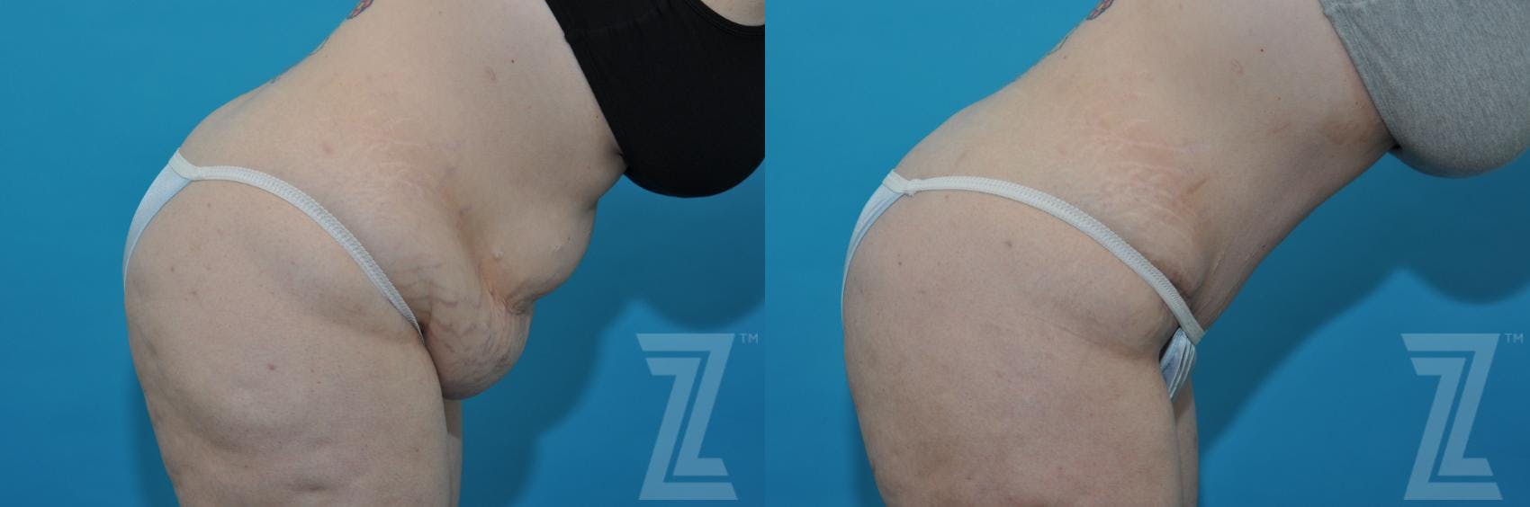 Tummy Tuck Before & After Gallery - Patient 132886824 - Image 6